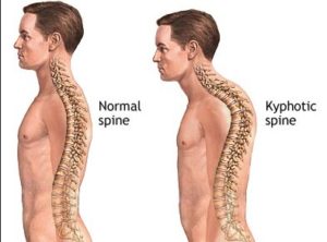 kyphotic spine