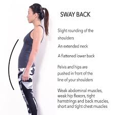swayback posture