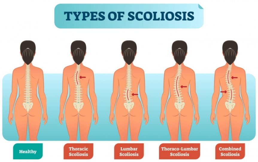 types of scoliosis
