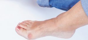 How to Get Rid of Bunions Naturally