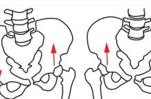 How to Fix a Lateral Pelvic Tilt